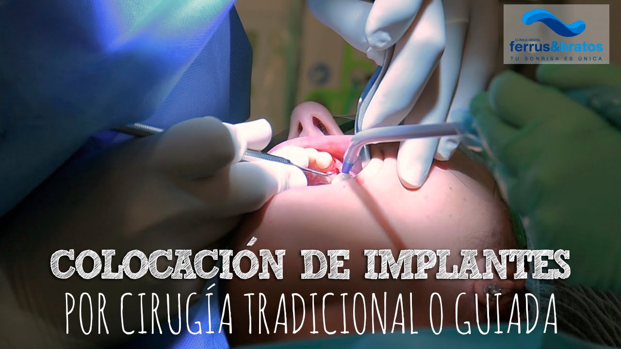 Colocación de implantes dentales