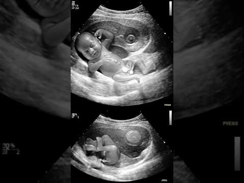 Ultrasound Pregnancy Twins Gender Identification Special interaction between the twins #shorts