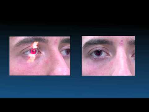 Achromatopsia - New Options in Contact Lenses Video