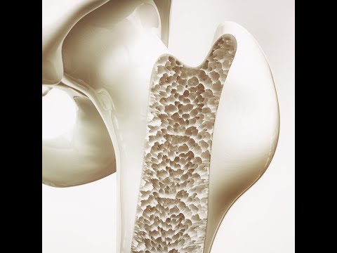 Osteoporoza, o boala silențioasă a sistemului osos