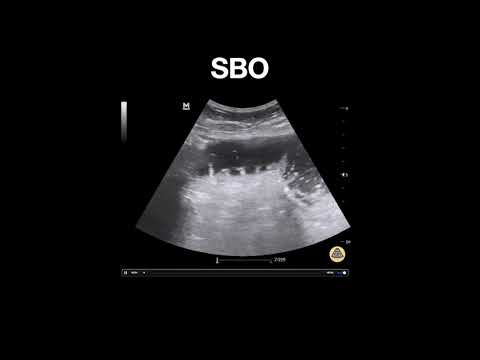 Small Bowel Obstruction