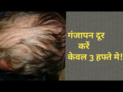 Hair Fall Treatment Bhringraj Oil