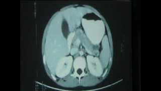 Surgical Radiology - CT of different diseases of Pancrease