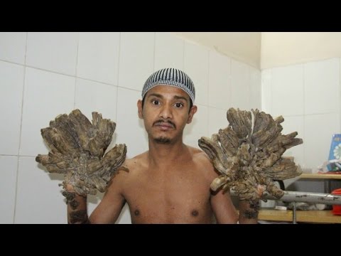 'Tree man' gets his hands back