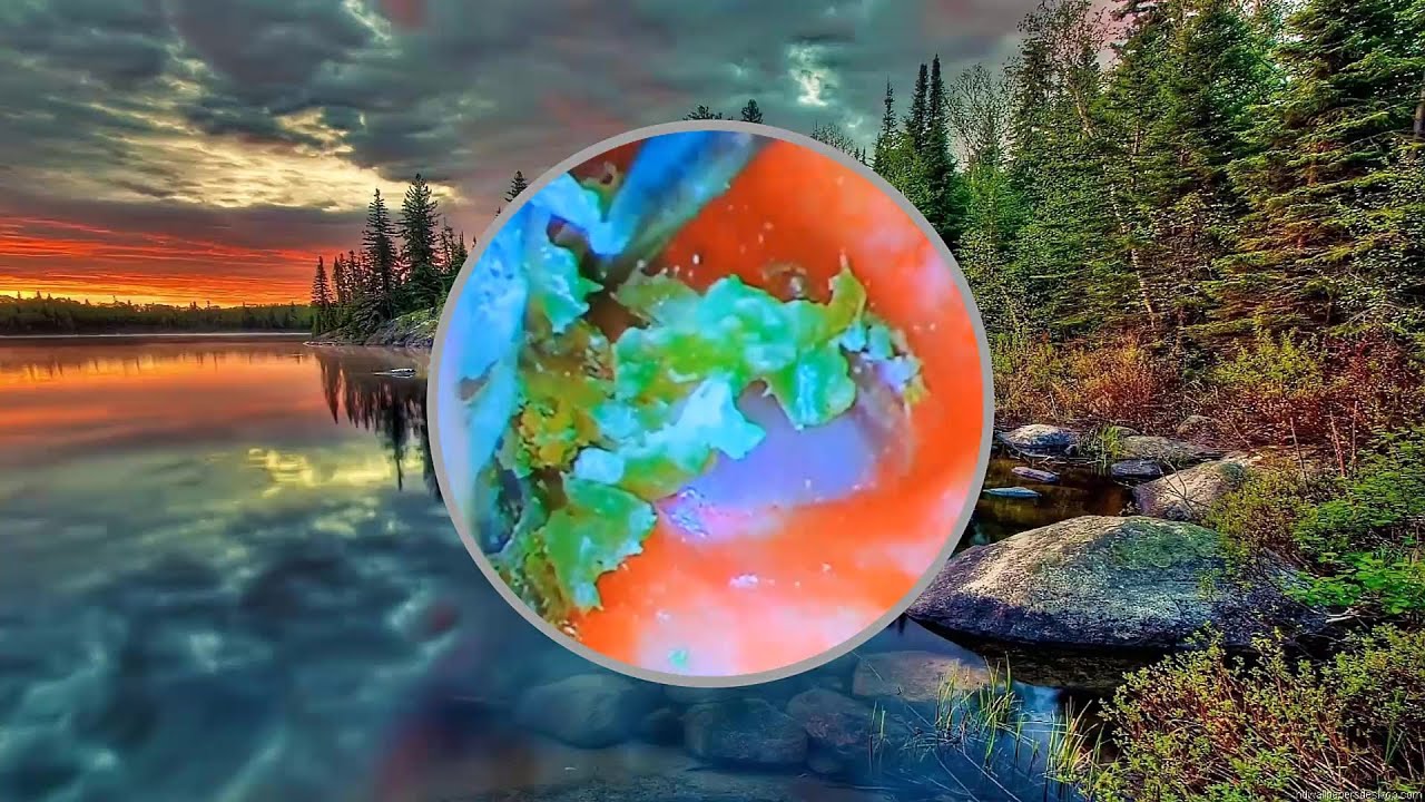 Vol.104 (耳掃除/耳垢の除去) - 難聴を伴う巨大な右耳垢 耳垢の除去、耳垢の除去、耳の掃除