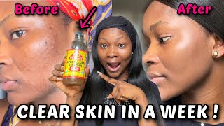 5 Methods to  Get rid of Acne with Apple Cider Vinegar in a week / 100% Effective!!