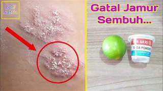 Download lagu Katakan Selamat Tinggal Pada GATAL-GATAL JAMUR mp3