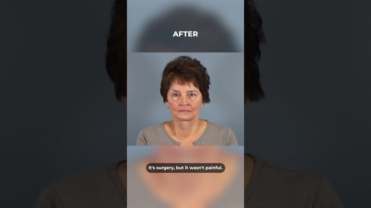 facelift journey