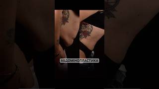 Пластика живота (абдомінопластика) 78