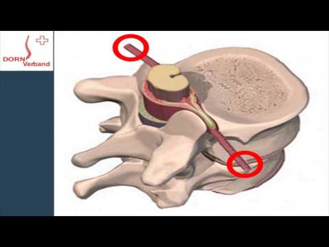 Drogen von Ischias Osteochondrose Koliken Schmerzen beim Urinieren