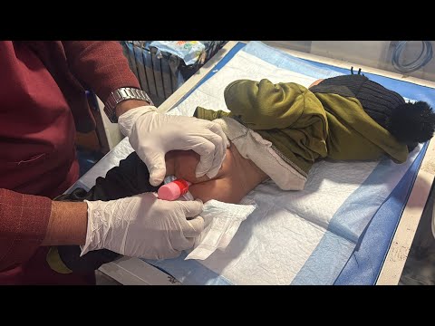 Baby Constipation | Micro-Enema Given in NICU (Educational Care)
