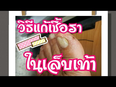 การรักษาใหม่สำหรับกลาก อาการเริ่มแรกของโรคสะเก็ดเงิน