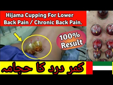 hijama cupping for back pain Dubai UAE +971529690123 | kamar dard ka hijama