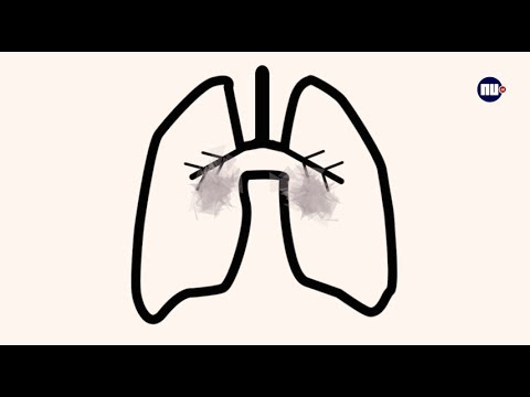 Tips van de dokter: Wat doet roken met je longen?