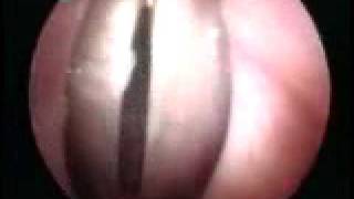 Flexible: Normal vocal cords up close