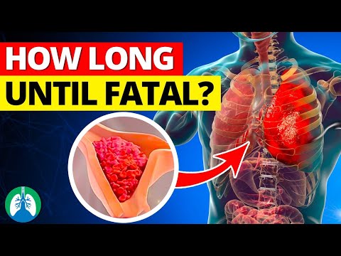 How Long for a Pulmonary Embolism to Become Fatal?