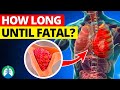 How Long For A Pulmonary Embolism To Become Fatal