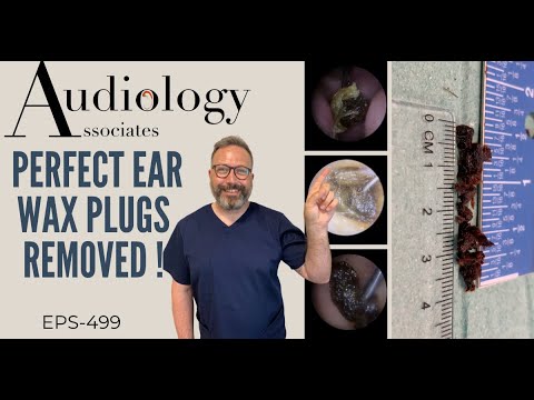 PERFECT EAR WAX PLUGS REMOVED - EP499