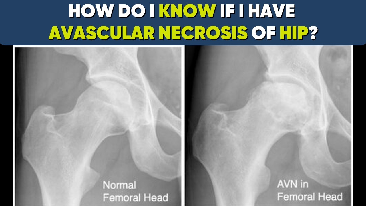 AVN & Hip replacement- How do u know if i need surgery ?
