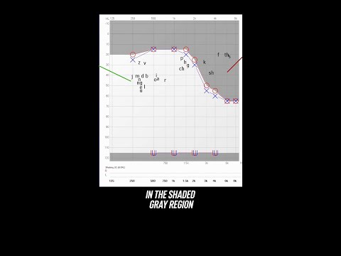 High-Pitch Hearing Loss Test Results Explained