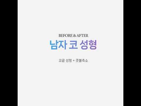 남자 코성형