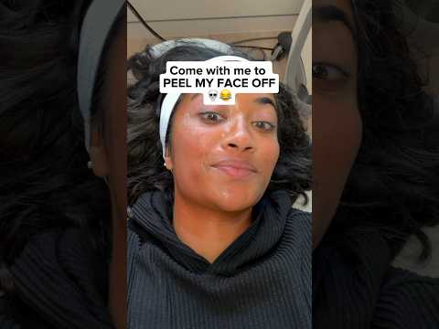 I GOT A ​⁠​CHEMICAL PEEL for my hyperpigmentation 👀 one of the ONLY peels safe for brown skin 🫶🏽