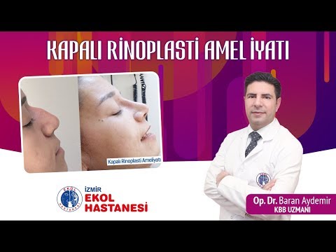 Kapalı Rinoplasti Ameliyatı - Op. Dr. Baran Aydemir - İzmir Ekol Hastanesi