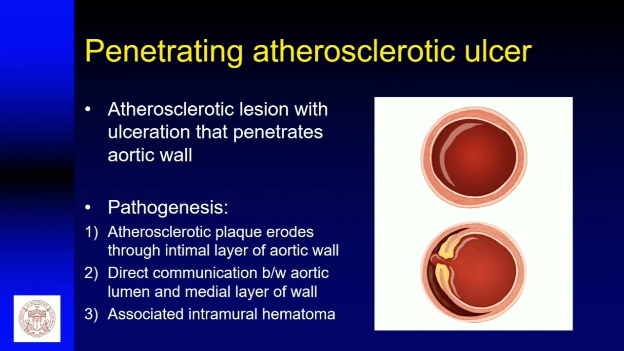 Acute Aortic Syndromes