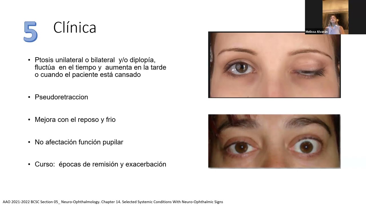 10 tips que debes de tener presente sobre la miastenia Ocular.
