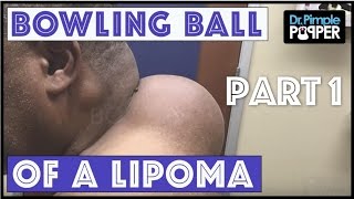 A Mother of a Lipoma Part One