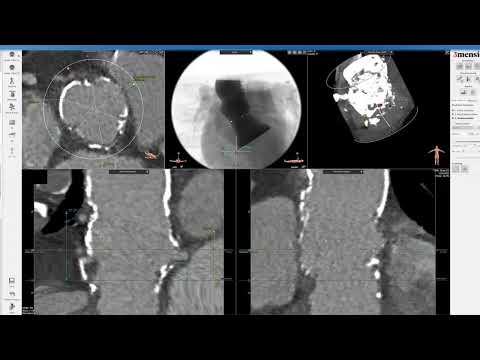 3Mensio CT Pre-case Planning: Valve-in-Valve TAVR in Homograft