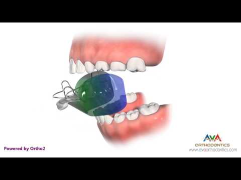 Orthodontic Treatment for Overjet (Overbite) - Bionator Appliance