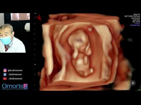 Ultrassonografia Gestação 12 semanas