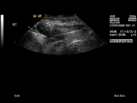 Ultrasound guided fine needle biopsy demonstrating the needle (white line) sampling the nodule