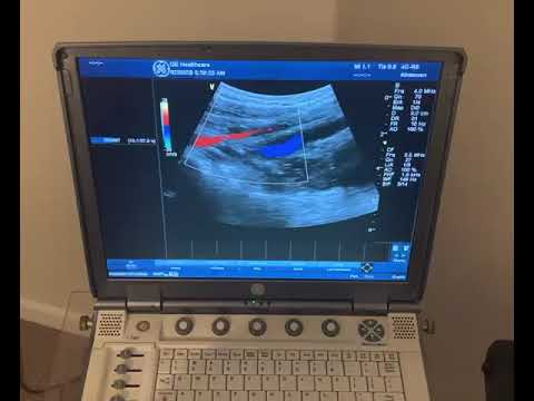 Ultrasound Imaging of the Common iliac arteries