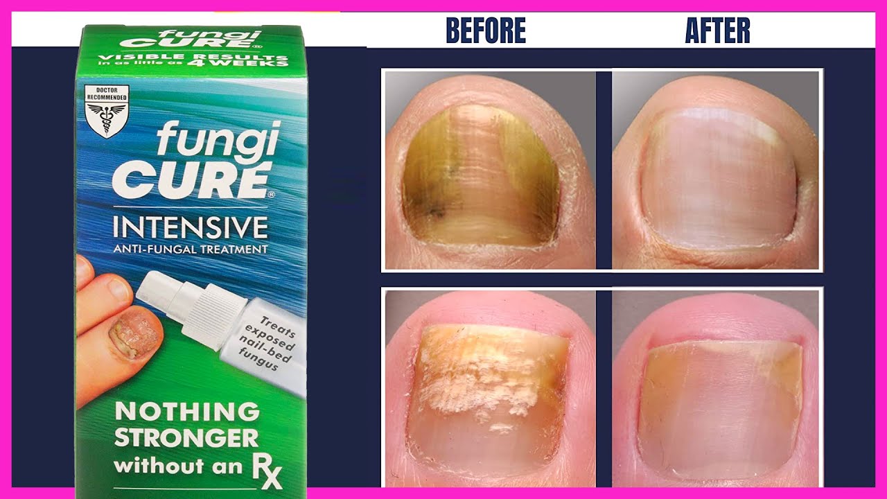 Top 5 Best Toenail Fungus Treatments of 2022 Reviews