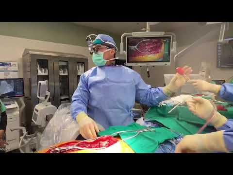 Final Screw Going In...