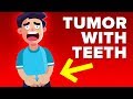 Man Grows Tumor With Teeth Inside Testicles