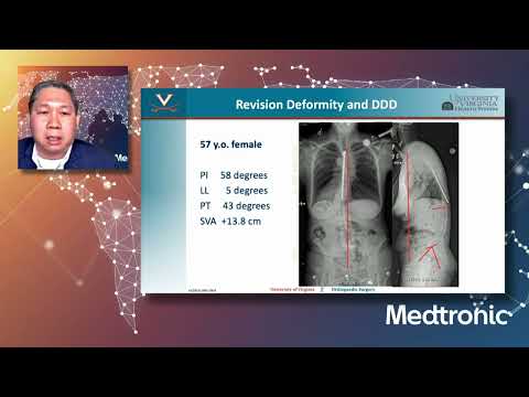 Lecture: Patient Selection and Medical Optimization in Adult Spinal Deformity