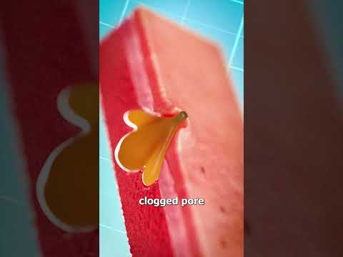 How Blackhead Extraction Works 😮