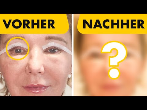 Oberlidstraffung - Sie hat 10 Tage lang jeden Tag ein Foto gemacht | Heilungsverlauf | Dr. Jungwirth