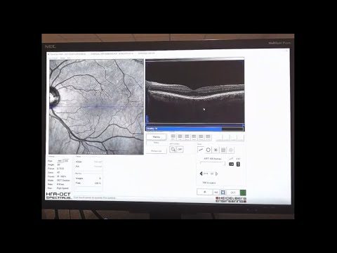 Recorded Webinar: OCT LIVE Virtual Workshop - Retina