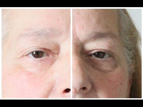 Il capogiro di occhi gonfiato Crema da rughe sotto occhi su effetto di Botox