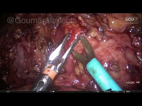 RIGHT LAPAROSCOPIC PYELOPLASTY  - PART 1 Isolation of UPJ