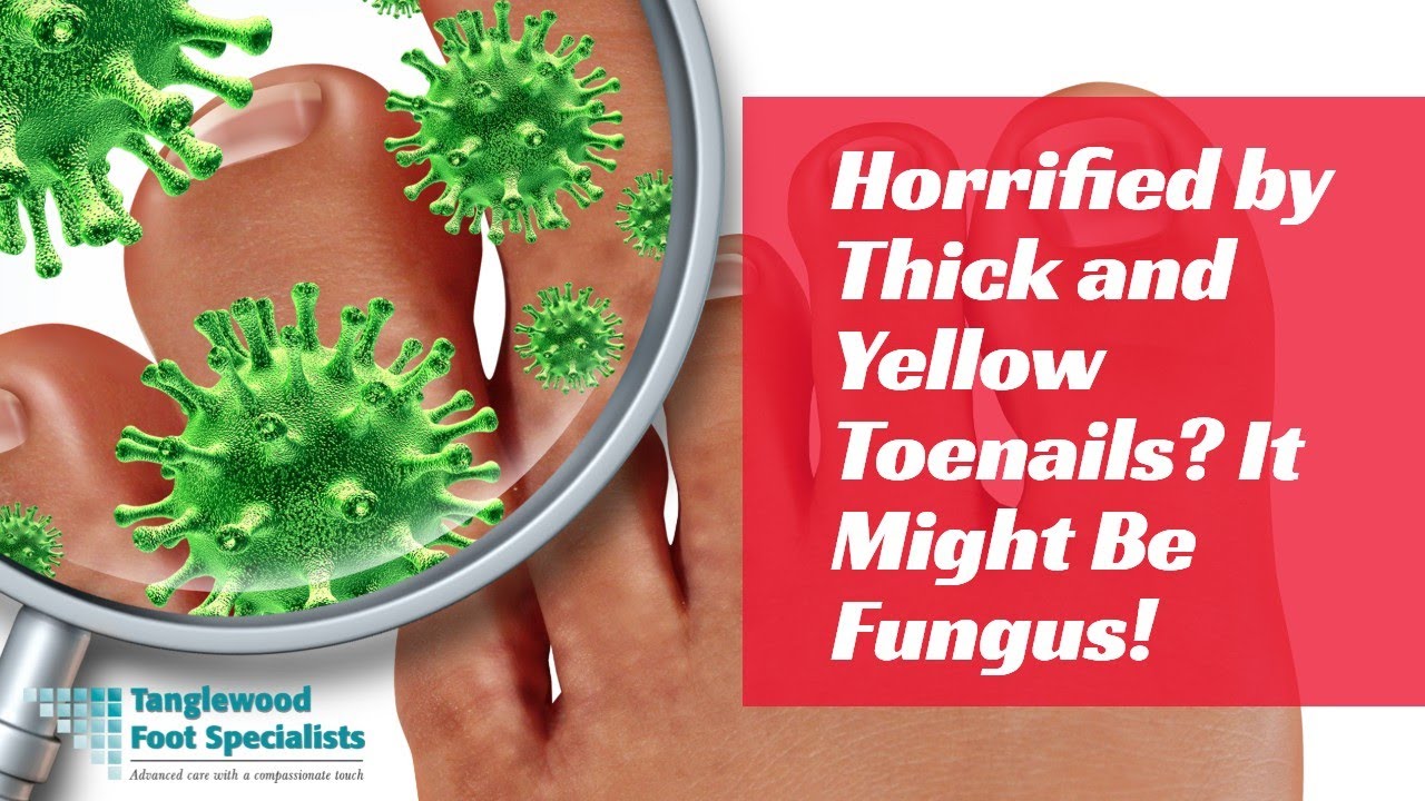 Horrified by Thick and Yellow Toenails? It Might Be Fungus!