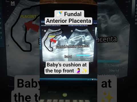 Fundal Anterior Placenta on Ultrasound 🍼 | Pregnancy Scan View #ultrasound #baby