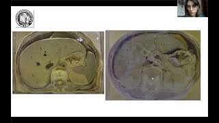 Duodenopancreas y bazo - Anatomía