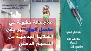 العلاج البديل لخشونة الورك بحقن الخلايا الجذعية - عيادات د.نزار الصلاحات