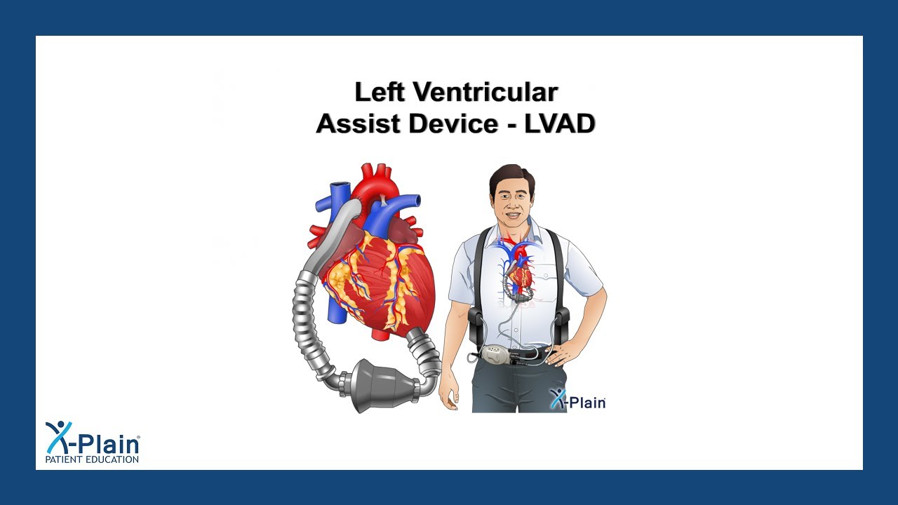 Left Ventricular Assist Device - LVAD
