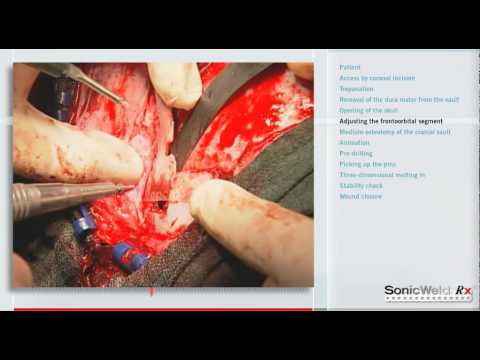 SonicWeld Rx® by KLS Martin – A new era in craniofacial osteosynthesis